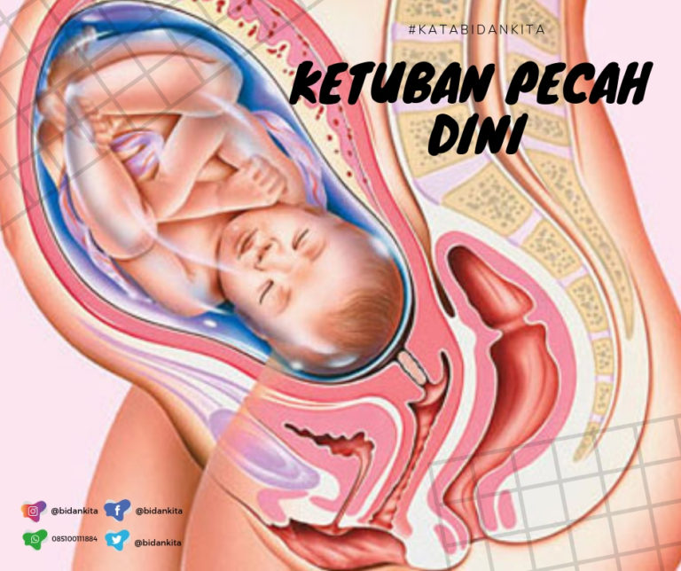 Ketuban Pecah Dini (KPD) atau Premature Rupture of The Membrane (PROM)