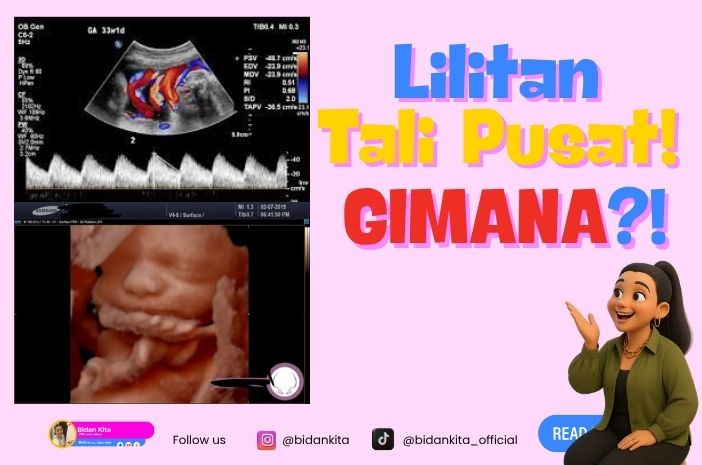 Lilitan Tali Pusat Bagaimana Nich?