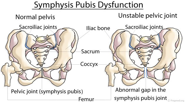 Symphysis-Pubis-Dysfunction