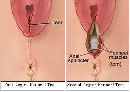 Melindungi perineum dari Robekan akibat Melahirkan