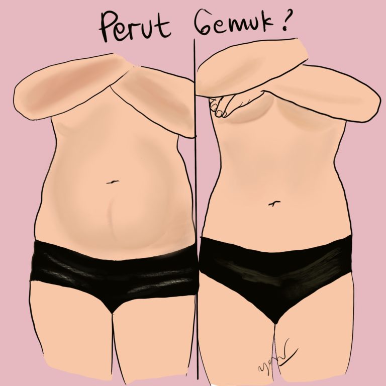 Apa Itu Diastasis Recti, Bagaimana Cara Mengembalikannya Seperti Semula?