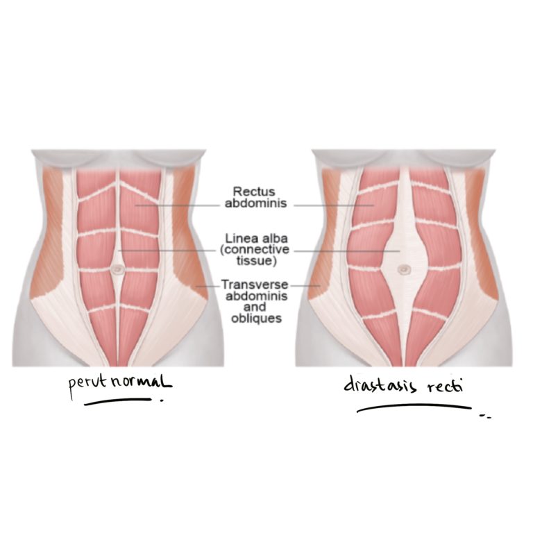 Diastasis Recti? Bagaimana Cara Mengobatinya?