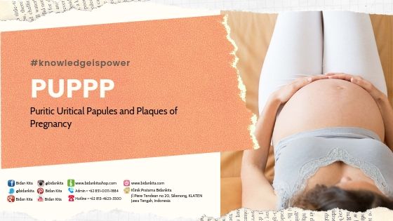 Apa Itu PUPPS (Puritic Papules and Plaque of Pregnancy) ?