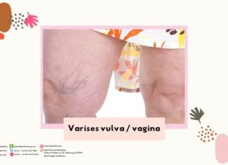 Varices Vagina Tips dan Trik kurangi keluhannya