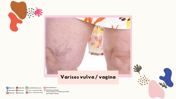 Varices Vagina Tips dan Trik kurangi keluhannya