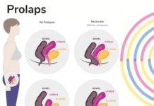 TURUN BEROK aliyas Prolaps Vagina? Apa Itu?