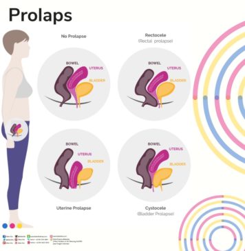 TURUN BEROK aliyas Prolaps Vagina? Apa Itu?