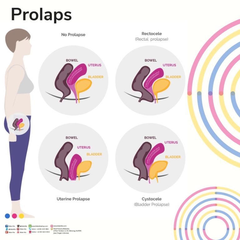 TURUN BEROK aliyas Prolaps Vagina? Apa Itu?