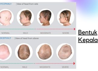 Bentuk kepala Peyang! Baguskah? Yuk kenali Brachycephaly & Plagiocephaly