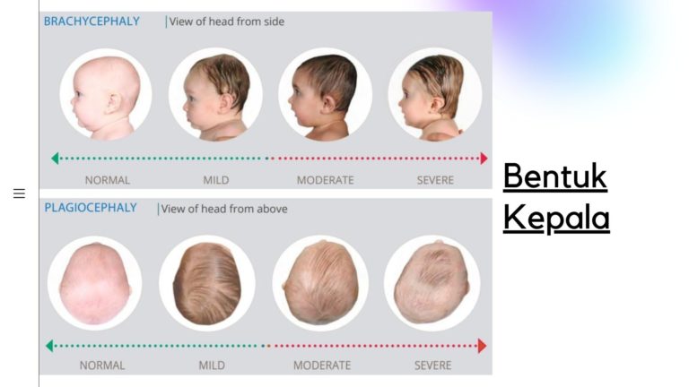 Bentuk kepala Peyang! Baguskah? Yuk kenali Brachycephaly & Plagiocephaly