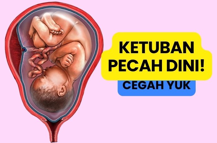 PENCEGAHAN KETUBAN PECAH DINI SECARA HOLISTIK PENCEGAHAN KETUBAN PECAH DINI SECARA HOLISTIK