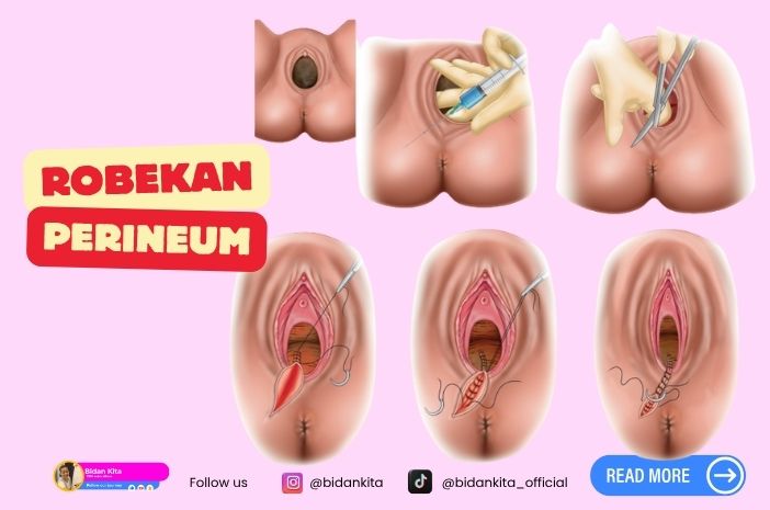 Robekan Perineum, Jahitan, dan Proses yang Sering Terlupakan